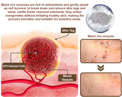 LOVILDS™Black Rice Skin Repair Essence Cream ⚕️ Health Canada Certified Certified (Eliminates warts and skin tags, relieves psoriasis, improves keratin build-up and follicular keratinization, fades pigmentation, sun spots & age spots)