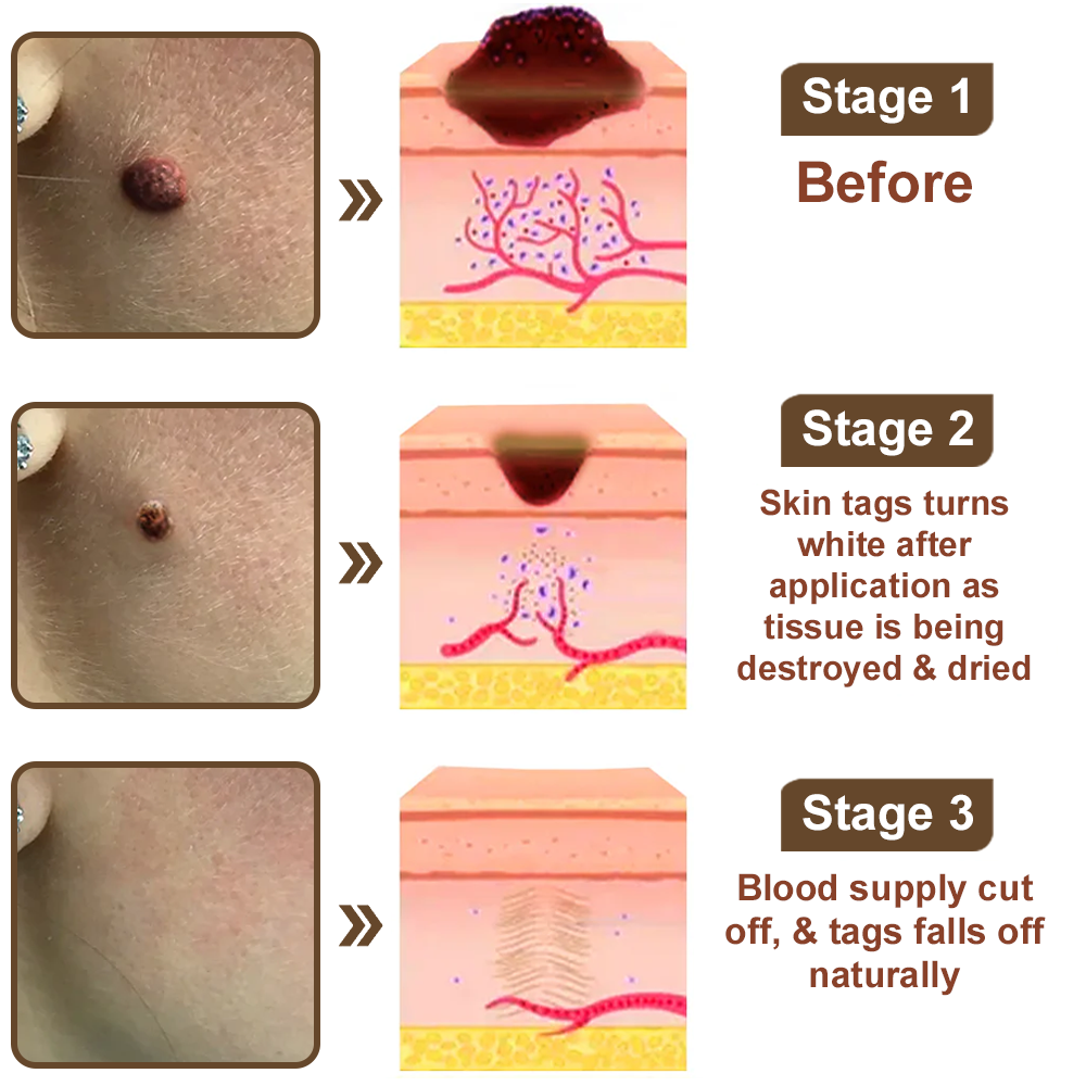 LOVILDS™Black Rice Skin Repair Essence Cream ⚕️ Health Canada Certified Certified (Eliminates warts and skin tags, relieves psoriasis, improves keratin build-up and follicular keratinization, fades pigmentation, sun spots & age spots)