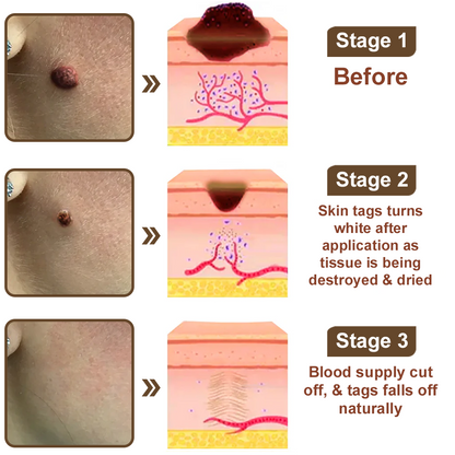 LOVILDS™Black Rice Skin Repair Essence Cream ⚕️ Health Canada Certified Certified (Eliminates warts and skin tags, relieves psoriasis, improves keratin build-up and follicular keratinization, fades pigmentation, sun spots & age spots)