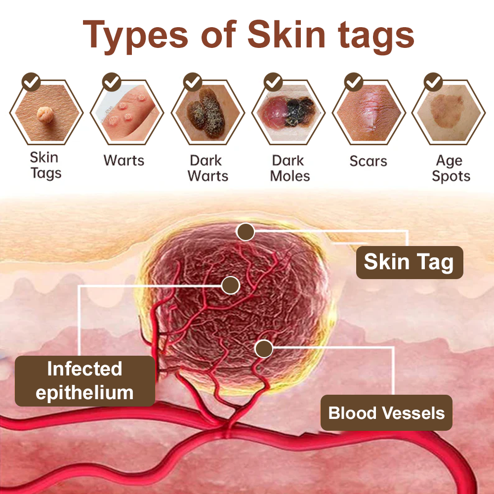 LOVILDS™Black Rice Skin Repair Essence Cream ⚕️ Health Canada Certified Certified (Eliminates warts and skin tags, relieves psoriasis, improves keratin build-up and follicular keratinization, fades pigmentation, sun spots & age spots)