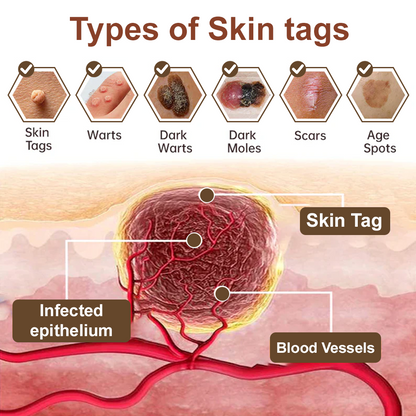 LOVILDS™Black Rice Skin Repair Essence Cream ⚕️ Health Canada Certified Certified (Eliminates warts and skin tags, relieves psoriasis, improves keratin build-up and follicular keratinization, fades pigmentation, sun spots & age spots)