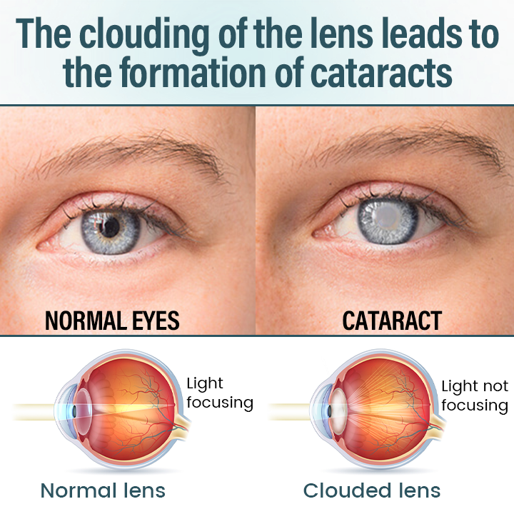 Medazy® Nano Eye Drops Serum —Nano Technology Restores Clear Vision,  No Glasses, No Surgery