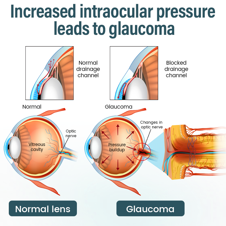 Medazy® Nano Eye Drops Serum —Nano Technology Restores Clear Vision,  No Glasses, No Surgery